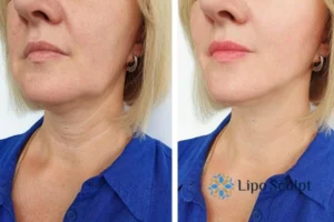 Double chin before and after Hi-Fu treatment 4 Book your double chin treatment Welford on Avon today! We are here to help!