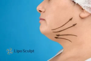 Double chin before and after Hi-Fu treatment 3 Boost your confidence with a Double chin treatment Welford on Avon