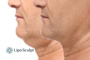 Double chin before and after Hi-Fu treatment 2 Double chin treatment Welford on Avon from Lipo Sculpt - feel more confident today!