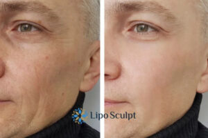 Fight Aging Symptoms Welford on Avon With HIFU and Morpheus8 Today!