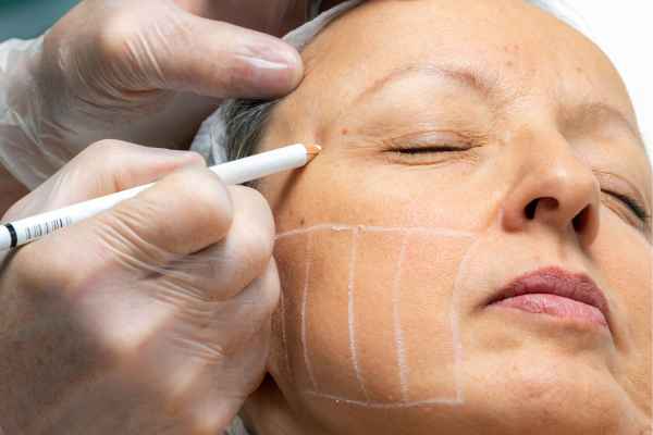 What should you ask before having CryoPen treatment Welford on Avon?