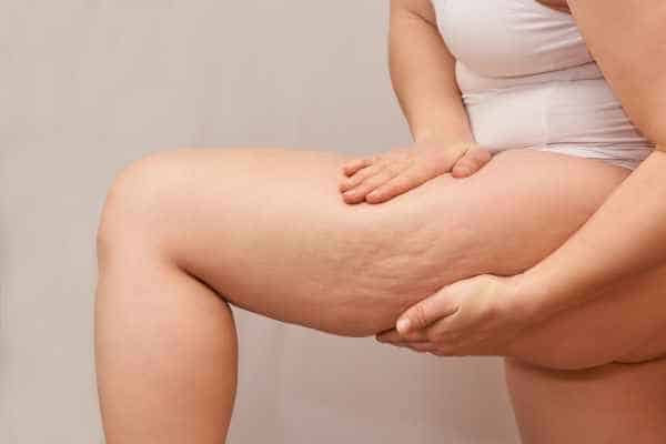 Find the best cellulite treatment Welford on Avon for you!