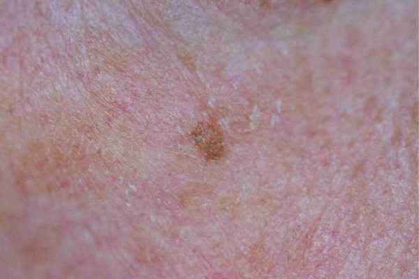 CryoPen for Seborrhoeic Keratosis: What to Know Before Treatment