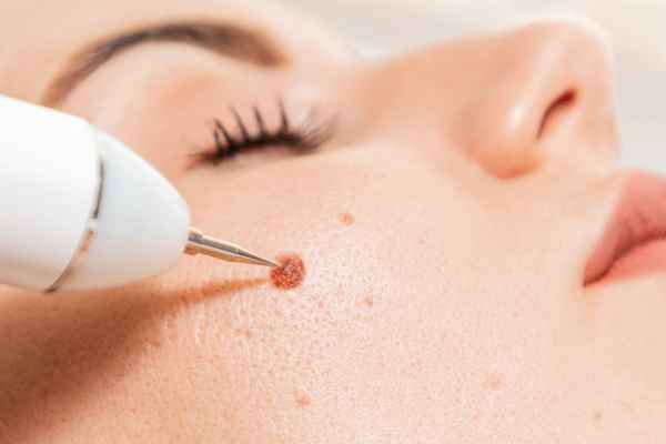 Could Cryotherapy Be Suitable for an Actinic Keratosis?