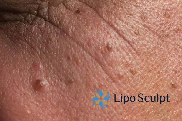 Remove skin lesions in as little as one treatment for an anti ageing Welford on Avon effect!
