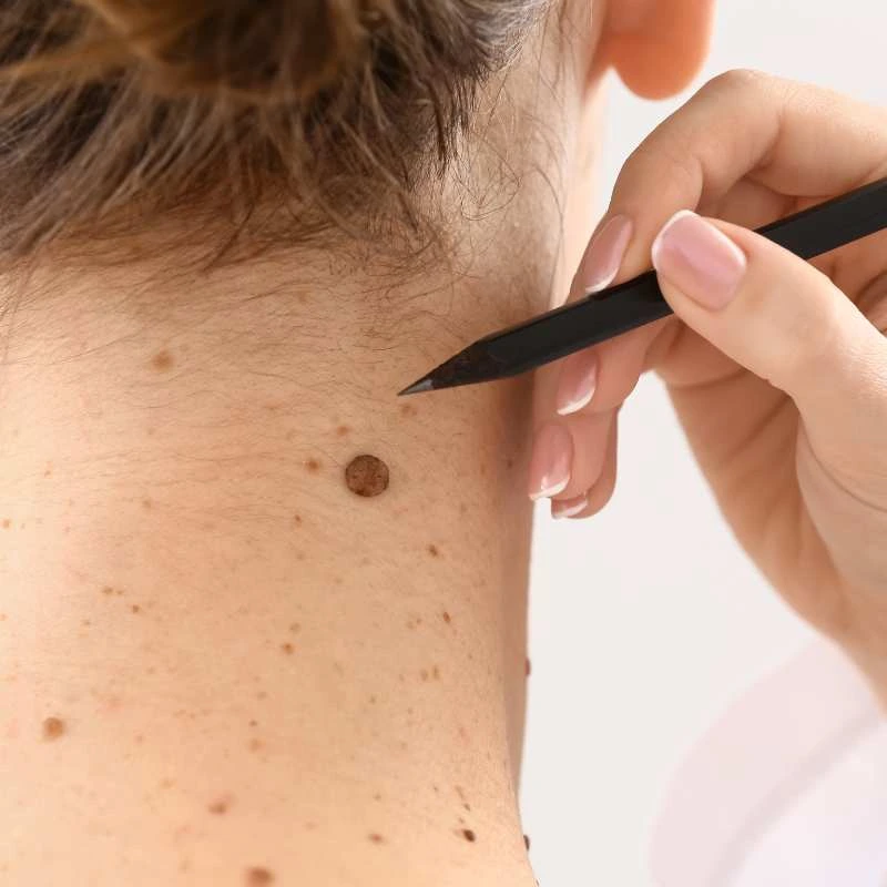 See our lesion removal prices Welford on Avon - call today for a free quote