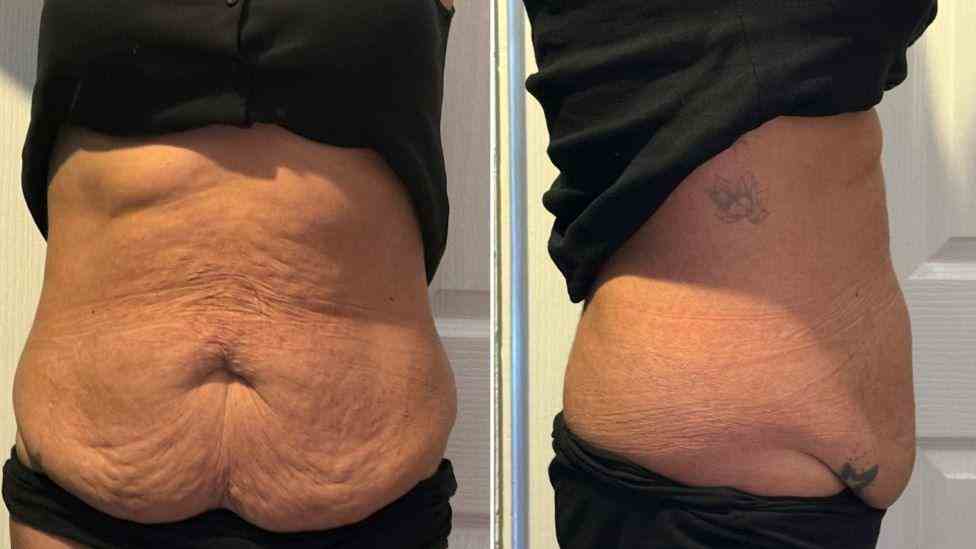 Lost the Weight but Not the Loose Skin? What You Should Know 1 Is It Definitely Loose Skin Welford on Avon?