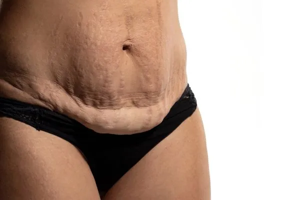 image of womans stomach after weight loss showing loose skin Welford on Avon 