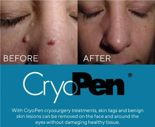 image of angiofibroma removal Welford on Avon using Lipo Sculpt cryopen!