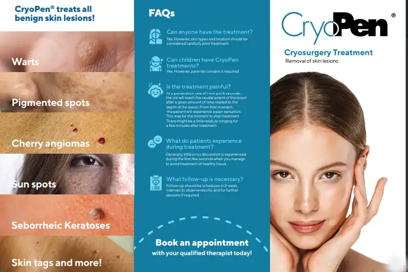 Benefits of Cryopen for seborrheic keratosis Removal Treatment Welford on Avon