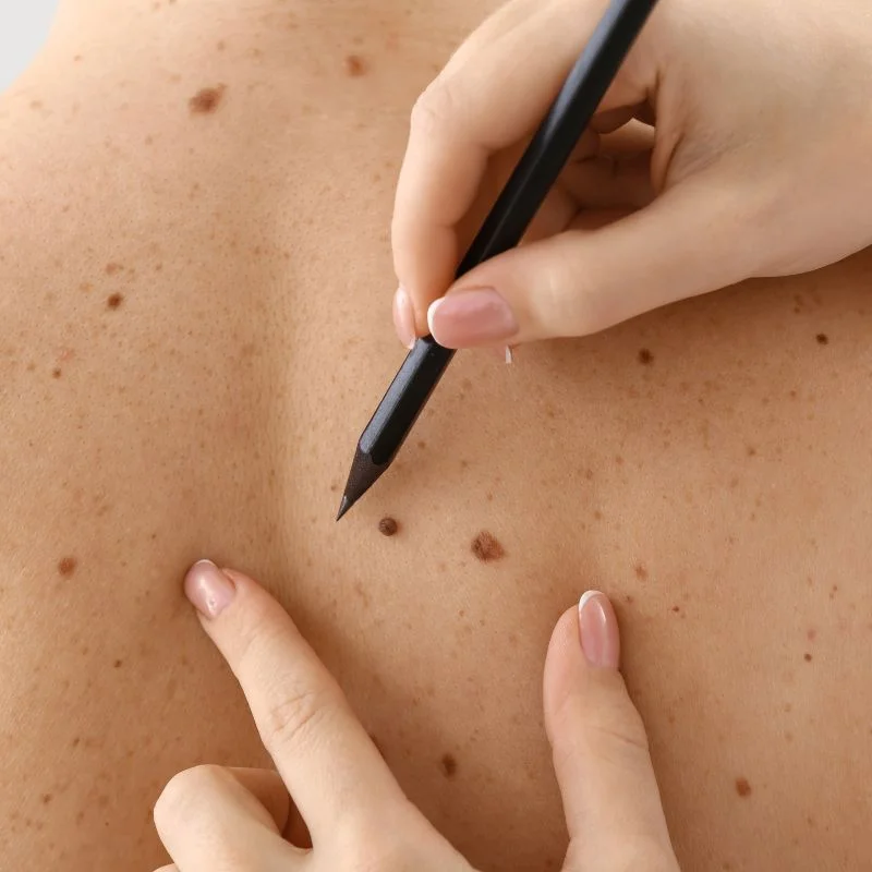 cryopen lesion removal treatment Welford on Avon