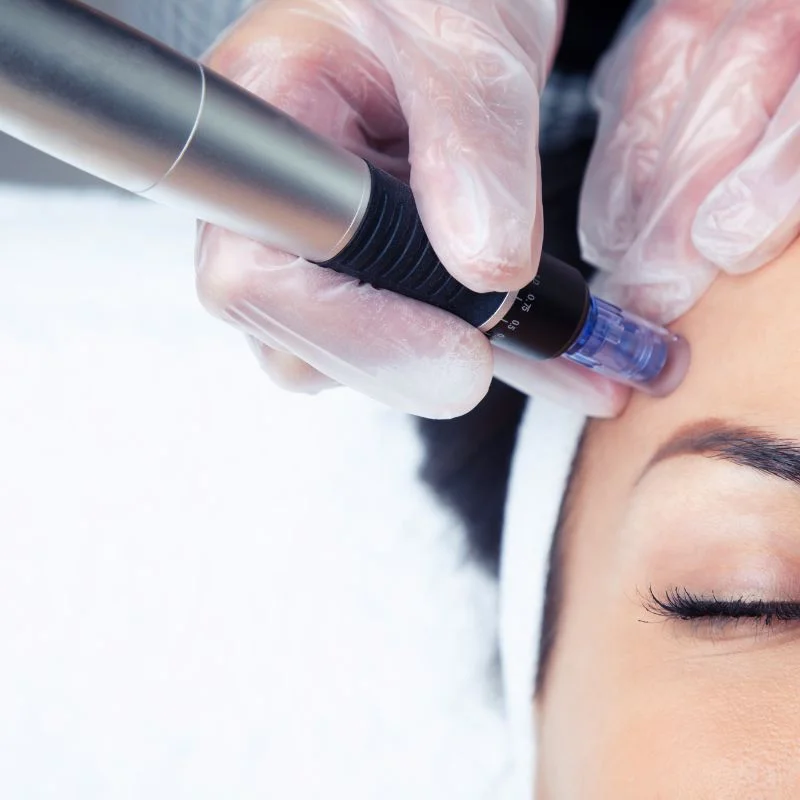 tightening treatment Welford on Avon