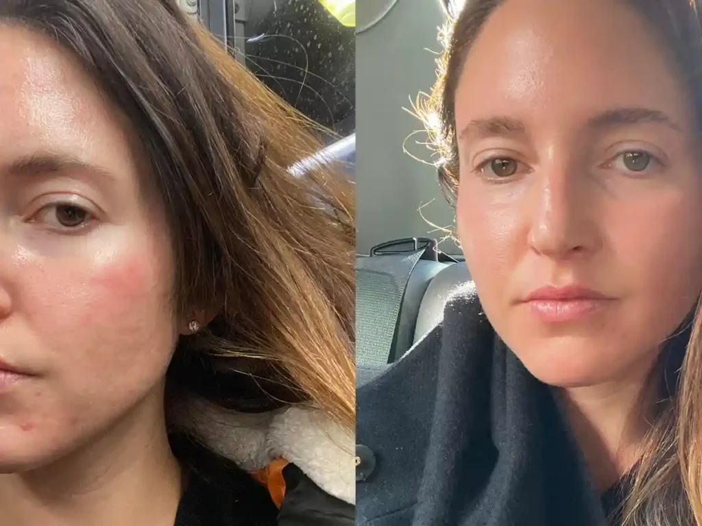 Explaining Total Skin Tightening Treatment and What to Expect